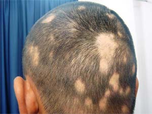 Tratament naturist pentru Alopecia areata - caderea parului pe terapii-naturiste.info