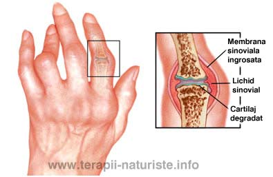 Artrita reumatoidă a tratamentului degetelor index. Meniu cont utilizator